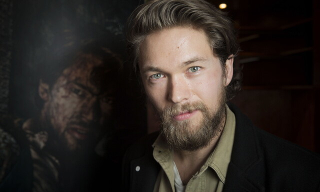 Har fått alvorlige brannskader i ansiktet